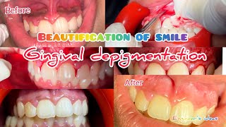 Beautification of smileGingival Depigmentation using scalpeldepigmentation [upl. by Yelsnik]