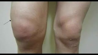 كيف نتخلص من ماء الركبة وإنصبابهاKnee joint effusion الدكتور عقبة نافع الناصري Uqba N Yousif [upl. by Nomyar]