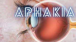 Aphakia  Ophthalmology Lecture [upl. by Nibor161]