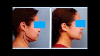 Sculpt the Chin amp Neck With Liposuction  Dr Sterry Explains [upl. by Garrot]