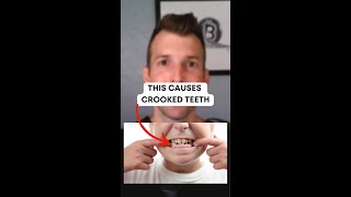 This Causes Crooked Teeth [upl. by Eachelle]