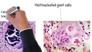 Sarcoidosis easy explained causes mechanism and pathology [upl. by Namialus]