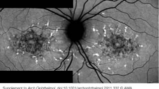 Centrifugal Expansion of Fundus Autofluorescence Patterns in Stargardt Disease Over Time Part 1 [upl. by Roxane587]