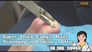 Super Thick Fungal Nails Trimming in Podiatry Office [upl. by Ivy]