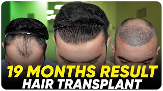 Hair Transplant Results  Best Cost amp Best Hair Transplant Result [upl. by Llenrep]