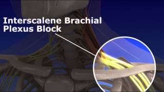 Interscalene Brachial Plexus Block [upl. by Corby]