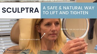 Does A Sculptra® Facelift Hurt [upl. by Hughmanick60]