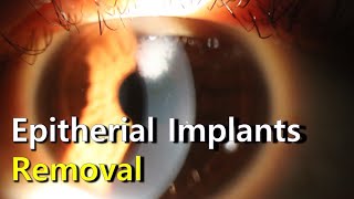 Manual Removal of Epithelial Implants [upl. by Ashling]