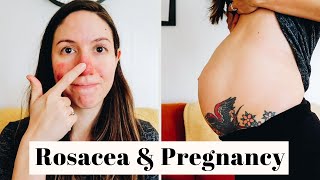 ROSACEA BENIGN PLACENTAL LAKES amp MORE  22 week pregnancy update [upl. by Hodosh]