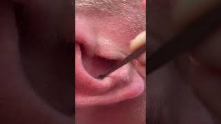 Removing psoriasis skin from the ear [upl. by Campy987]