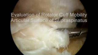 Arthroscopic Rotator Cuff Repair  Large Supraspinatus and Infraspinatus Tear [upl. by Alikam470]