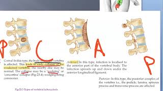 Orthopedics Potts spine Paraplegia Tuberculosis of Bone Tuberculous Osteomyelitis Minerva Jacket [upl. by Boony]