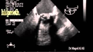 multiple small thrombi on mitral bioprosthetic valve [upl. by Steffin]