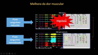 Toxina botulínica na DTM  o que você precisa saber [upl. by Yrevi]