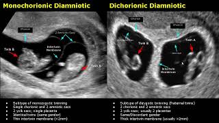 Fetal Twins Ultrasound Normal Vs Abnormal  MonochorionicDichorionicDiamnioticMonoamniotic USG [upl. by Fendig]