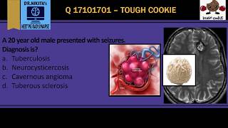 POPCORN CALCIFICATION BRAIN  CAVERNOMACAVERNOUS ANGIOMA [upl. by Assile]