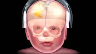 Coronal Growth Anterior  Craniosynostosis Surgery [upl. by Tracey]