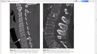 CLINICAL IMAGING OF SPINAL TRAUMA [upl. by Ennayllek21]