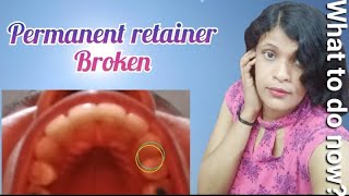 Retainer Broke  Metal retainer broke  Permanent retainer happysstyle priyankaartiyadav6298 [upl. by Cressi]