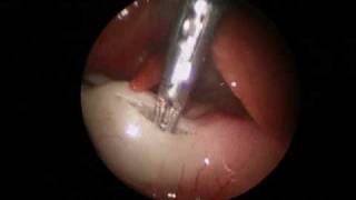 Laparoscopic pyloromyotomychapter 2 spread and completion of myotomy [upl. by Atival449]