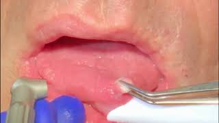 Solea Fibroma removal  Dr Heath Brantley Narrated [upl. by Marutani574]