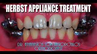 Herbst appliance treatment Case PL  Athanasios Ton Nasiopoulos Orthodontist [upl. by Neelhtak]