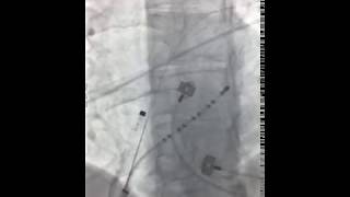 AF ablation with Rhythmia system [upl. by Hathaway]