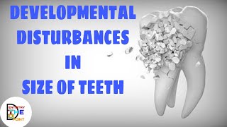 DEVELOPMENTAL DISTURBANCES IN SIZE OF TEETH [upl. by Areip]