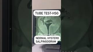 HSG  Tube patency test infertility biology medico pregnancy motherhood baby motivation [upl. by Salli498]