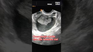 Hemorrhagic ovarian cyst with retraction clot [upl. by Enuahs]