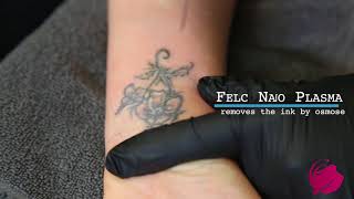 Tattoo Removal with Felc Nano Plasma [upl. by Grosvenor]