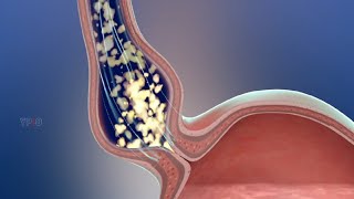 Achalasia Dilation Indications Preparation Procedure Risks and Complications [upl. by Postman]