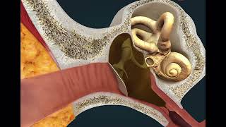 “Otitis Media Explained Causes Effects and Paracentesis Treatment [upl. by Fannie]