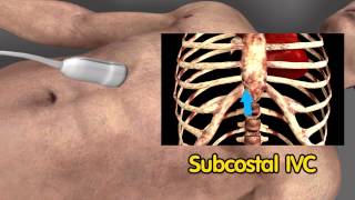 Echocardiographic view  Subcostal view  Inferior vena cava [upl. by Ellehsal]