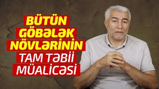 Bütün göbələk növlərinin tam təbii müalicəsi  Fizuli Hüseynov [upl. by Eldwen]