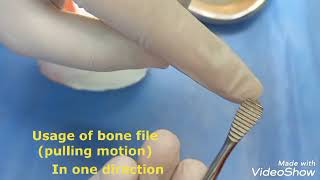 Removal of sharp bony spiculesedges after tooth extraction few minutes of oral surgery [upl. by Merridie849]