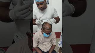 Hair loss treatment video hair regrowth low price prp and GFC treatment 9734984030BiharMalda [upl. by Kenta]