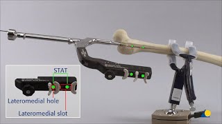 Femur Proximal  Fracture  Intramedullary Fixation Using the Expert RAFN  Antegrade Procedure [upl. by Miquela675]