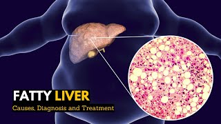 Fatty Liver Causes Signs and Symptoms Diagnosis and Treatment [upl. by Seaden]