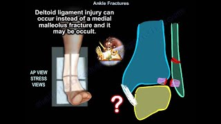 Ankle Fractures  Everything You Need To Know  Dr Nabil Ebraheim [upl. by Namron911]