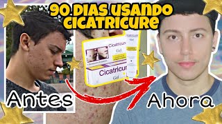 El mejor tratamiento para eliminar CICATRICES de ACNÉ Use CICATRICURE por 90 días y ¡esto pasó [upl. by Koppel]