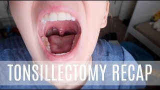 TONSILLECTOMY RECAP [upl. by Montford]