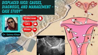 Displaced IUCD Causes Diagnosis and Management – Case Study healthytips DrSaimakhan [upl. by Buchbinder444]