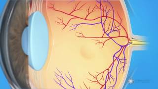 What is cystoid macular edema [upl. by Kwei]