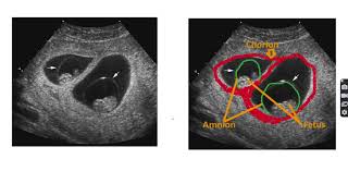 Anatomy of monochorionic diamniotic twin pregnancy twin anatomy pregnancy twinpregnancy [upl. by Lee]