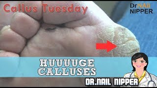 Absolute Monster Callus HUUUUGE Foot Calluses 26  Callus Tuesday Huge Callus [upl. by Lothar838]