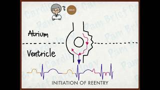 Reentry tachycardia mechanism [upl. by Aisetal]