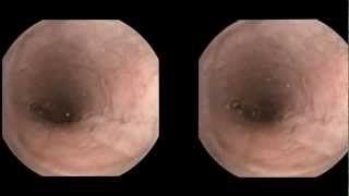 Esophageal varices detected by capsule endoscopy [upl. by Acilegna]