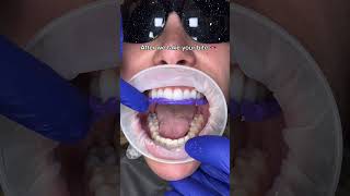 How we make bottom temporary smile before cementing permanent veneers teethclean 🦷beadrepair [upl. by Skyler]