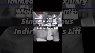 Immediate Maxillary Molar Implant with Simultaneous Indirect Sinus Lift [upl. by Seavey]